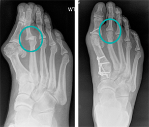 Second Metatarsal Shortening Osteotomy Surgery Procedure Recovery second-metatarsal-shortening-osteotomy-surgery-procedure-recovery