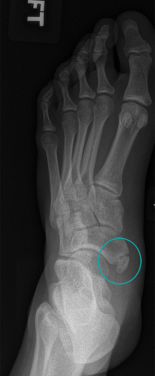 X-ray image of accessory navicular