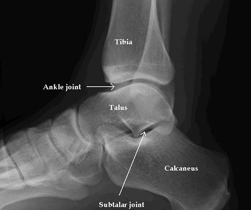 Ankle X-ray