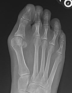 Bunion X-ray