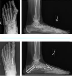 Flatfoot Reconstruction