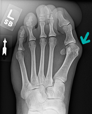 Bunion X-ray