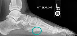 Jones Foot Jones Fracture Symptoms & Causes | FootCareMD